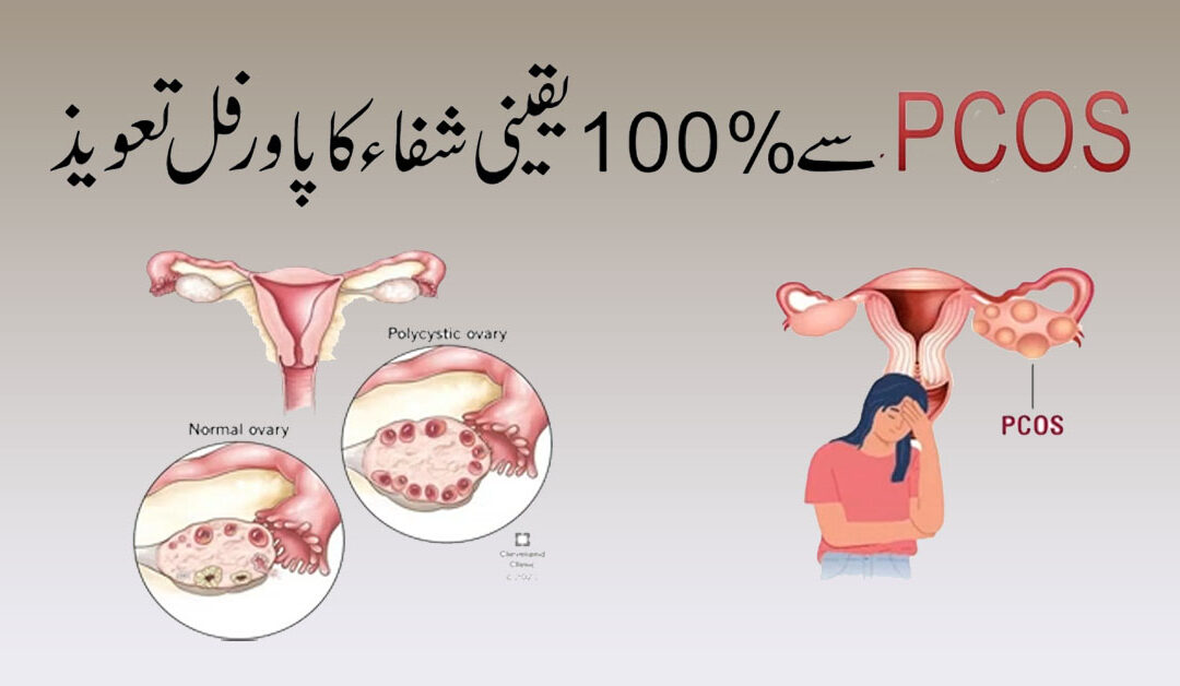 PCOS Se 100% Shifa Ka Powerful Naqsh