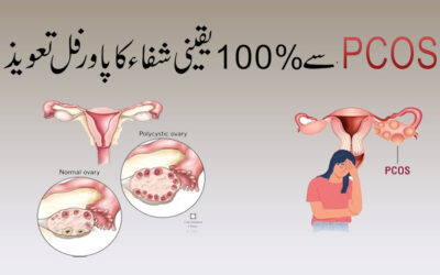 PCOS Se 100% Shifa Ka Powerful Naqsh