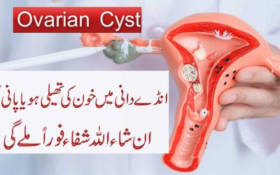 Treatment of Ovaries Cysts